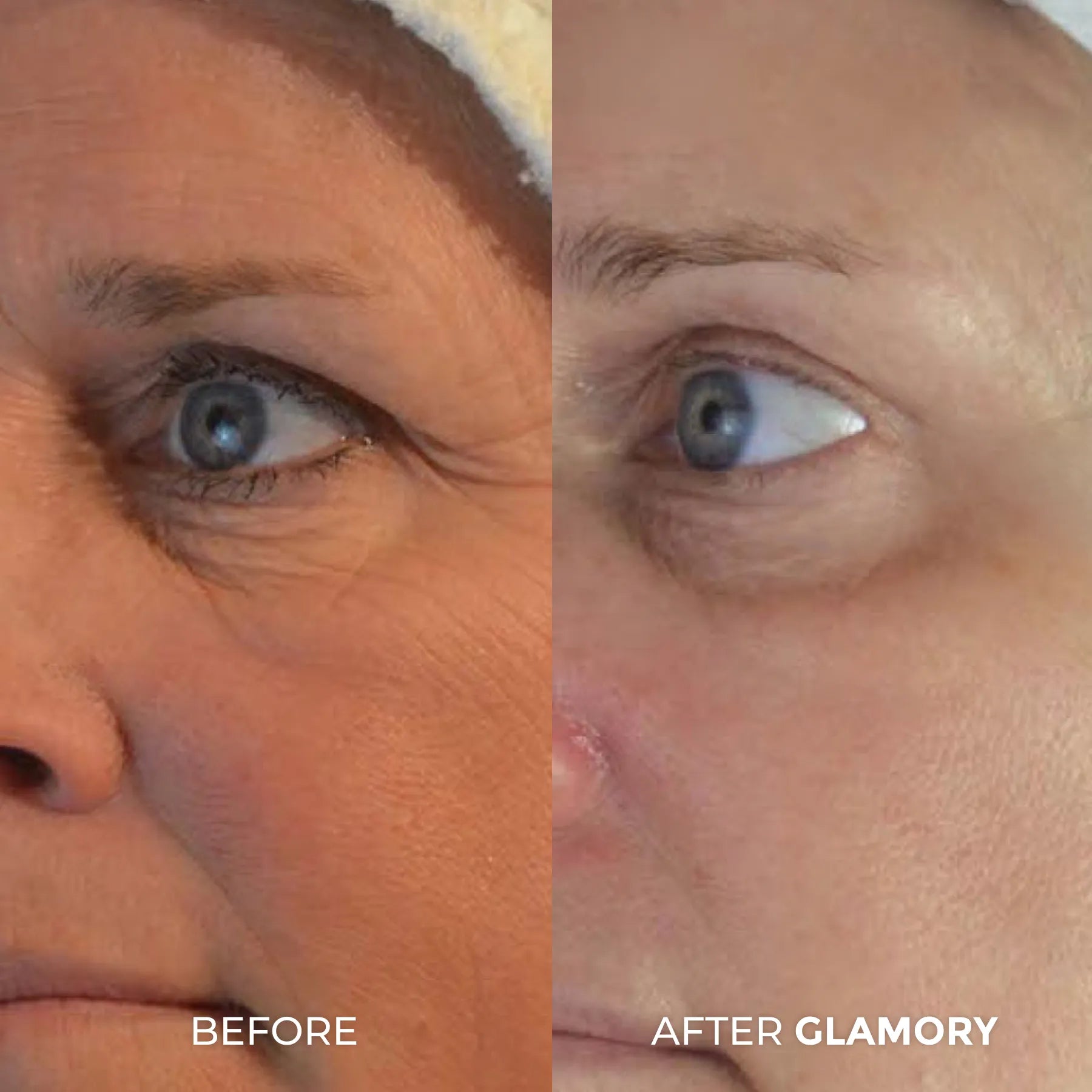 Erase Years of Aging  at Home in Just 5 Minutes