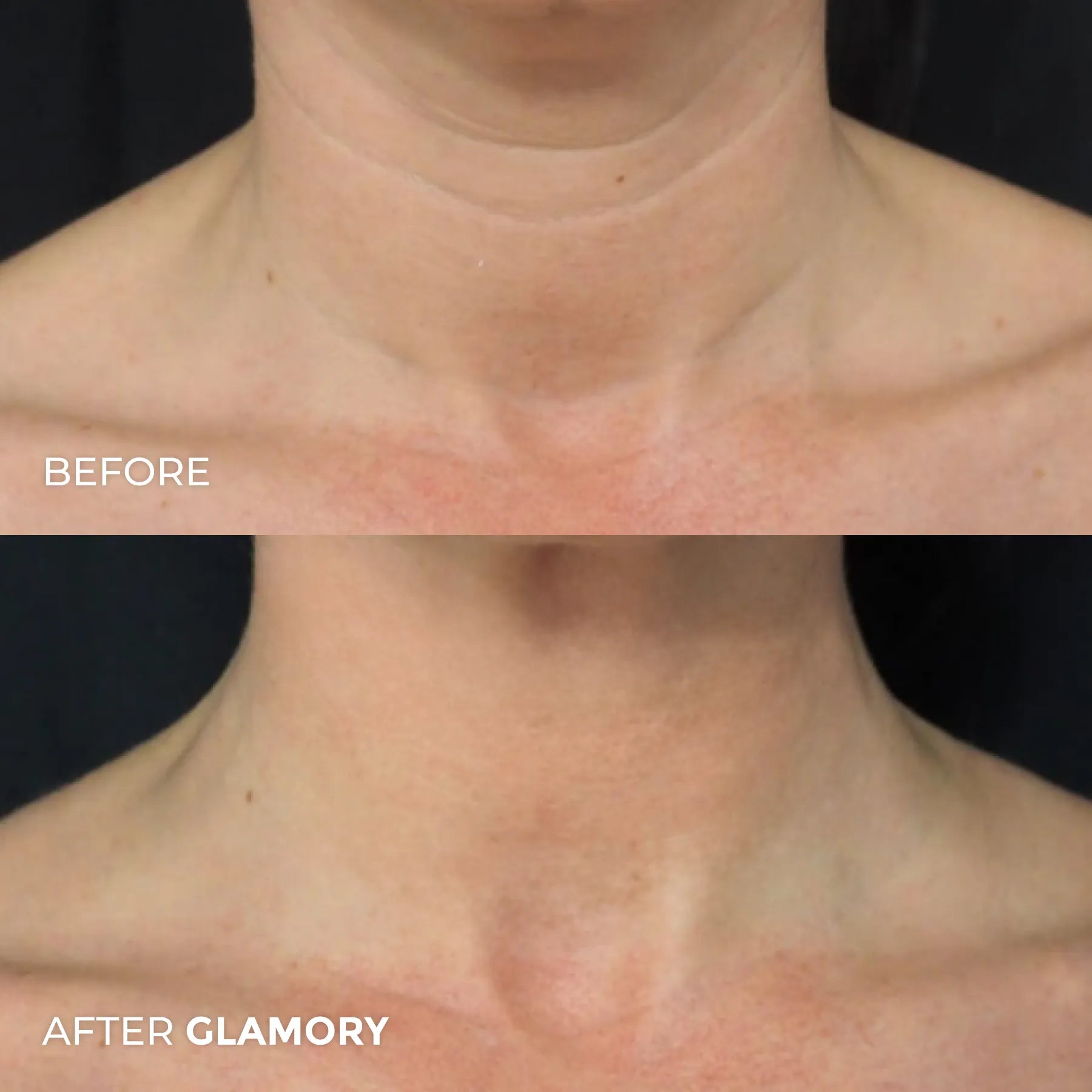 Erase Years of Aging  at Home in Just 5 Minutes