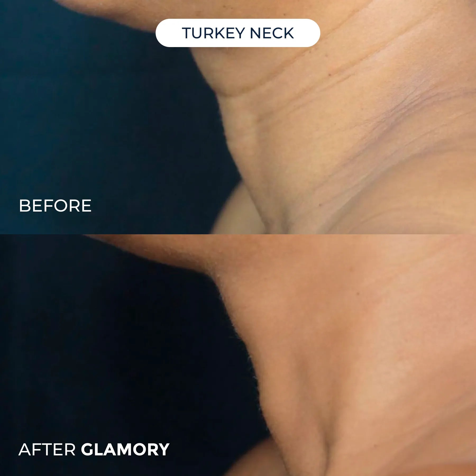 Erase Years of Aging  at Home in Just 5 Minutes